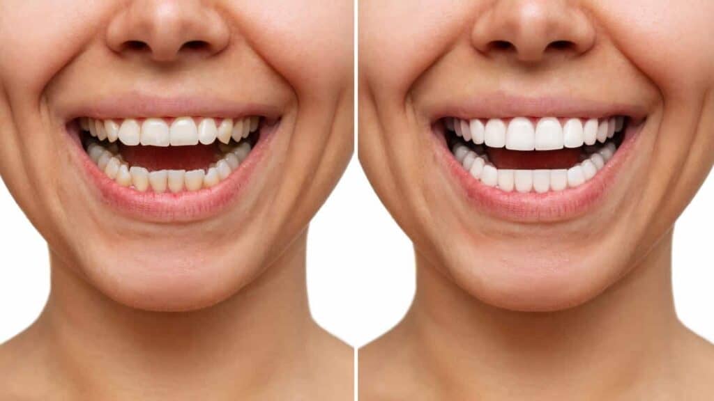 Contact Aspire White for teeth whitening services – Get in touch with West Bromwich today