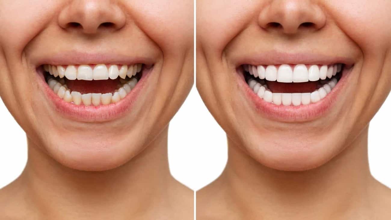 Contact Aspire White for teeth whitening services – Get in touch with West Bromwich today