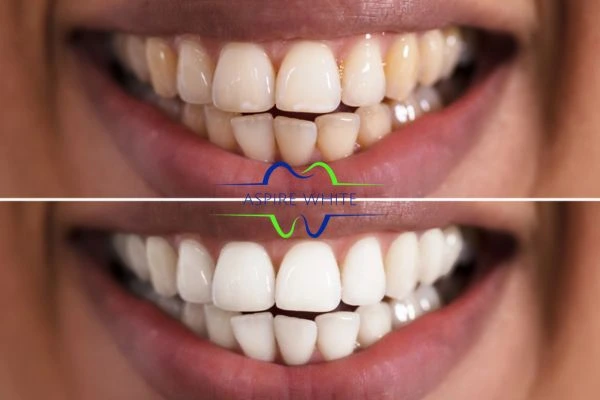 Aspire White customer before and after West Bromwich results.