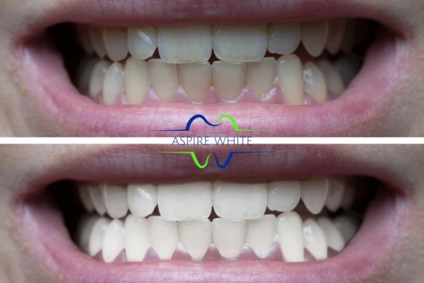 1 hour laser teeth whitening before and after results West Bromwich