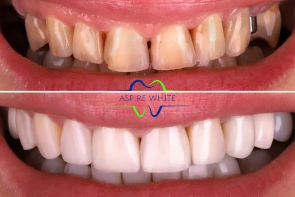 Before And After Results West Bromwich