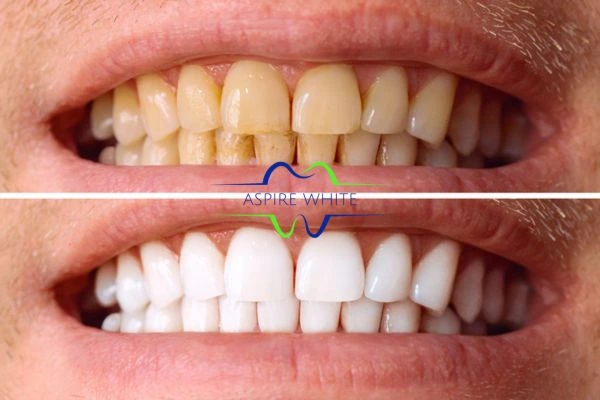 Get noticeable whiter smile in just one hour! Book your teeth whitening treatment West Bromwich today!