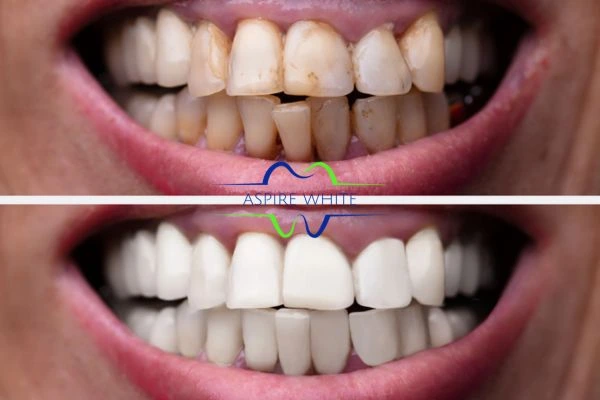 Before and after results of laser teeth whitening West Bromwich Book in online today!