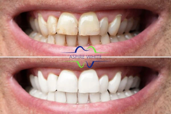 Achieve a radiant smile with professional laser teeth whitening West Bromwich